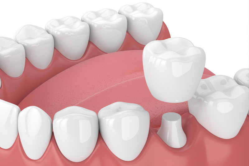 Dental Crowns in Lutherville-Timonium