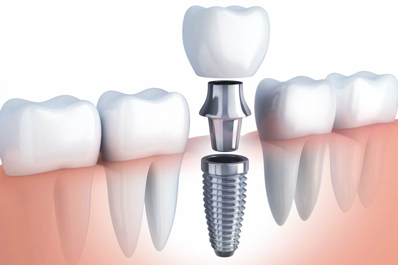 Implants Dentist in Lutherville-Timonium