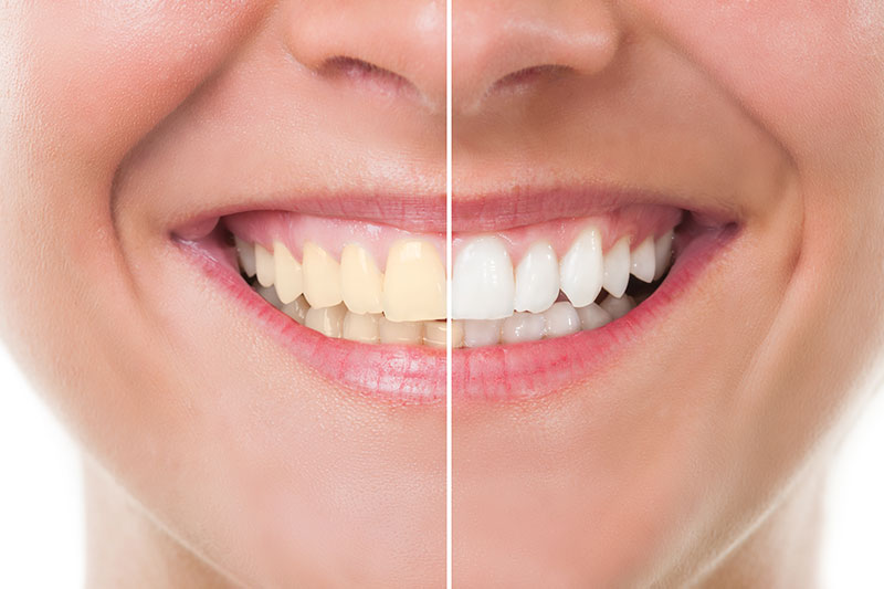 Teeth Whitening in Lutherville-Timonium