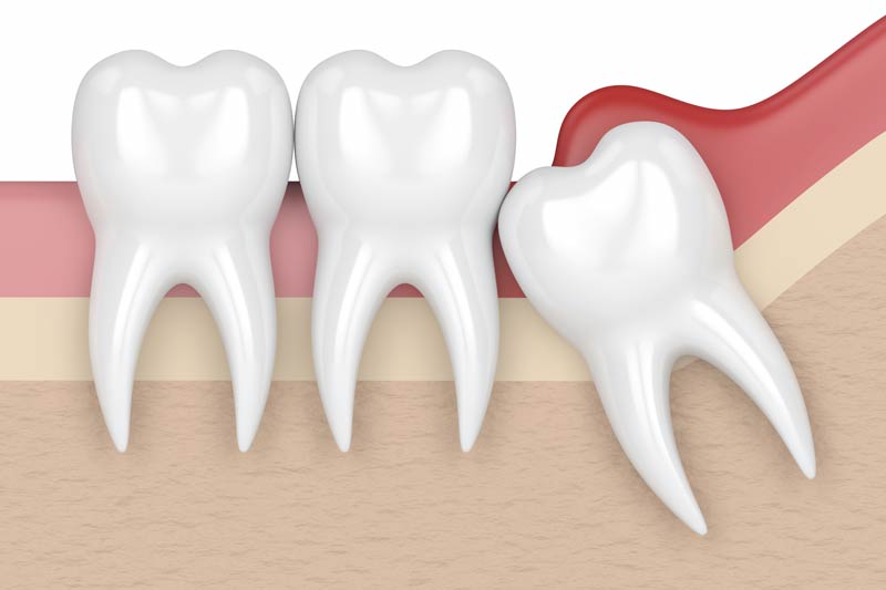 Wisdom Tooth Removal in Lutherville-Timonium